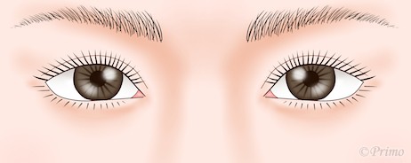 下眼瞼拡大術（たれ目形成）イラスト